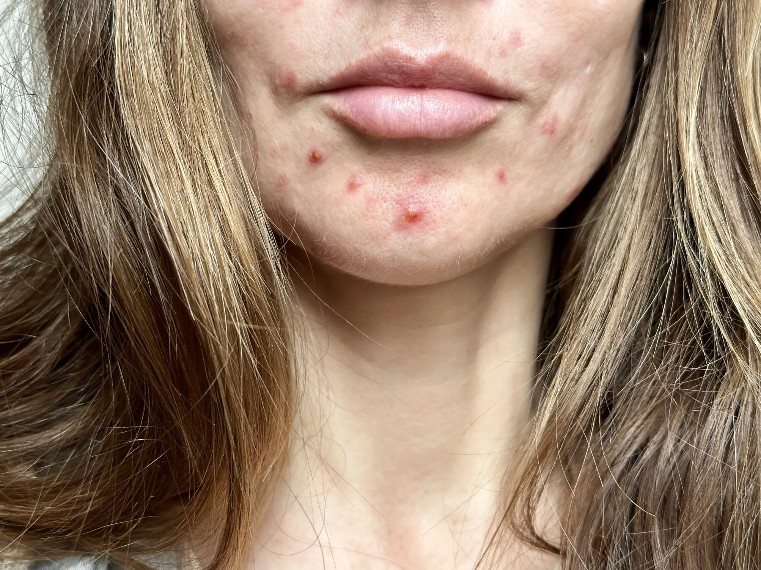 Acne & Acne Scarring - Gaughf Dermatology