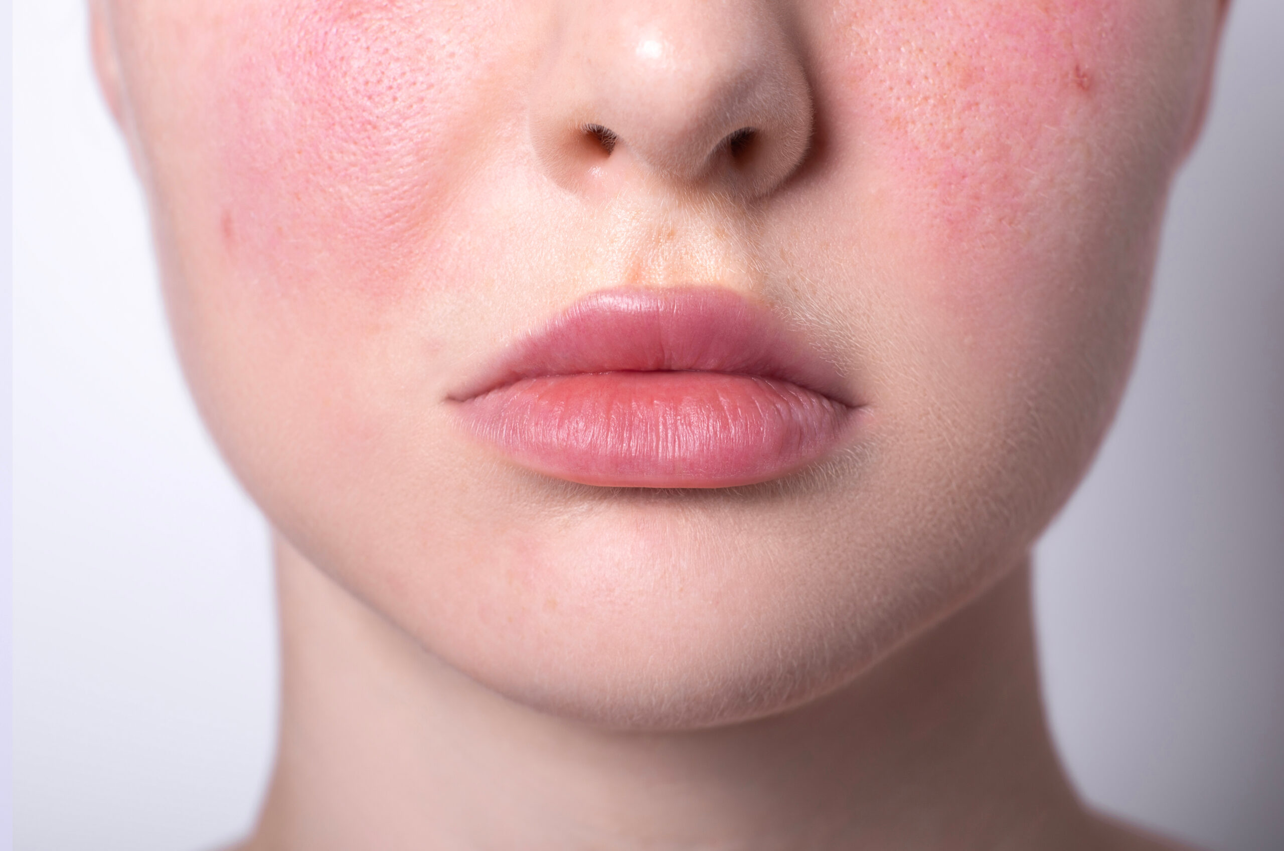 Rosacea - Gaughf Dermatology
